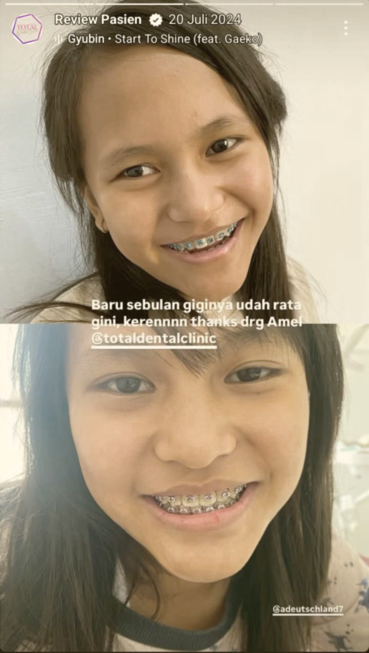 Behel/Braces