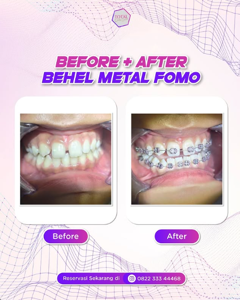 Behel/Braces